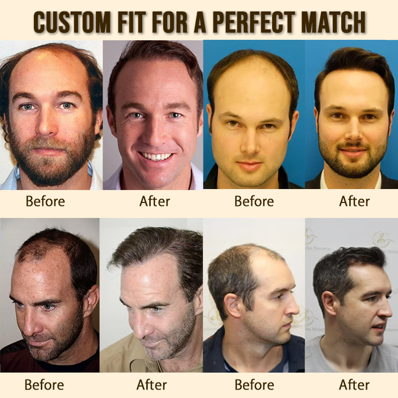 Sugoola® GhostLine Invisible Secret Frontal Hairline System 🇬🇧 100% Natural, Reliable for High    Forehead