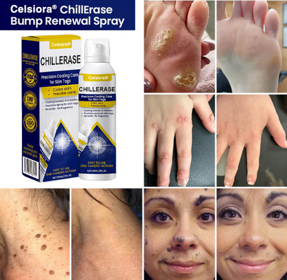 ❄️ Celsiora® ChillErase Cooling Spray for Skin Tags 🇬🇧 Made in UK
