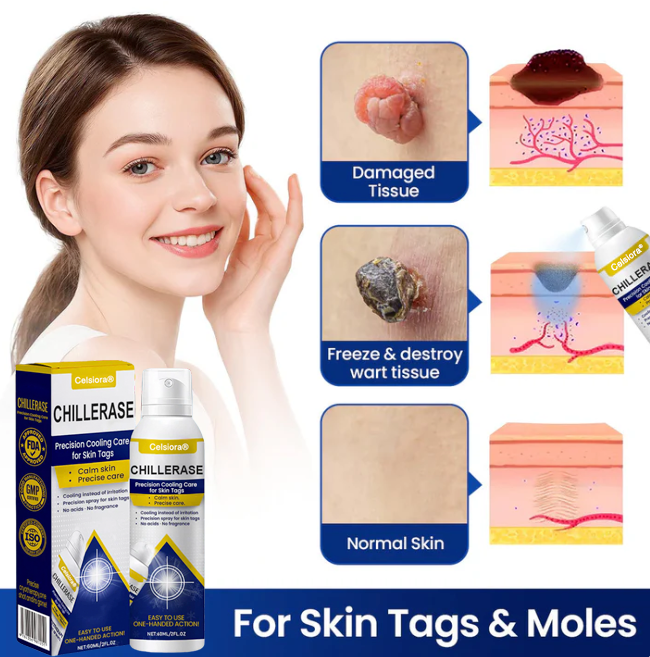 ❄️ Celsiora® ChillErase Cooling Spray for Skin Tags 🇬🇧 Made in UK