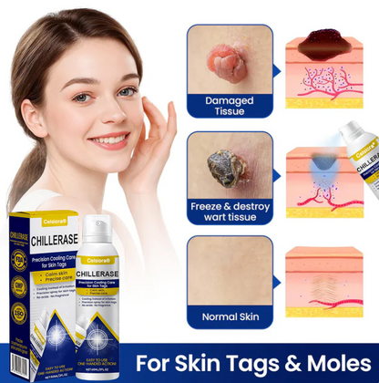❄️ Celsiora® ChillErase Cooling Spray for Skin Tags 🇬🇧 Made in UK