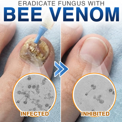 🇬🇧 CareBreeze® Fungi Free Bee Venom Nail Treatment 🌱