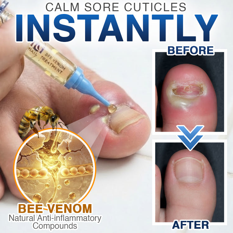 🇬🇧 CareBreeze® Fungi Free Bee Venom Nail Treatment 🌱
