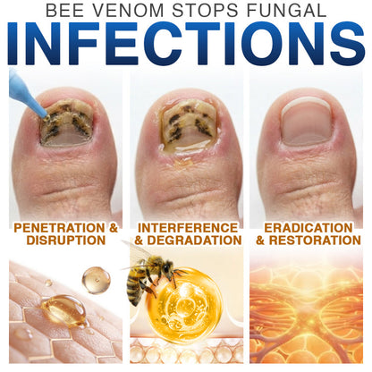 🇬🇧 CareBreeze® Fungi Free Bee Venom Nail Treatment 🌱