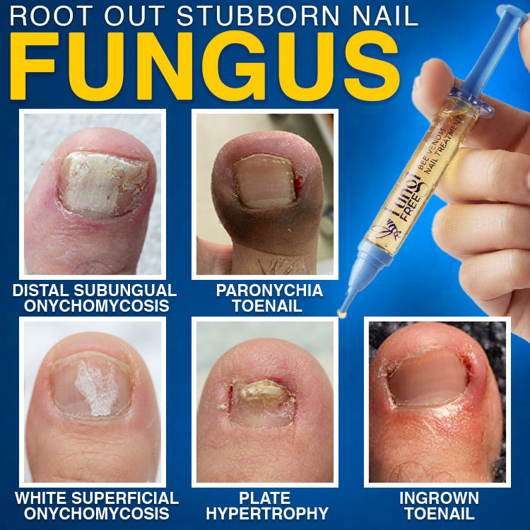 🇬🇧 CareBreeze® Fungi Free Bee Venom Nail Treatment 🌱