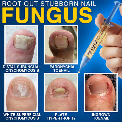 🇬🇧 CareBreeze® Fungi Free Bee Venom Nail Treatment 🌱