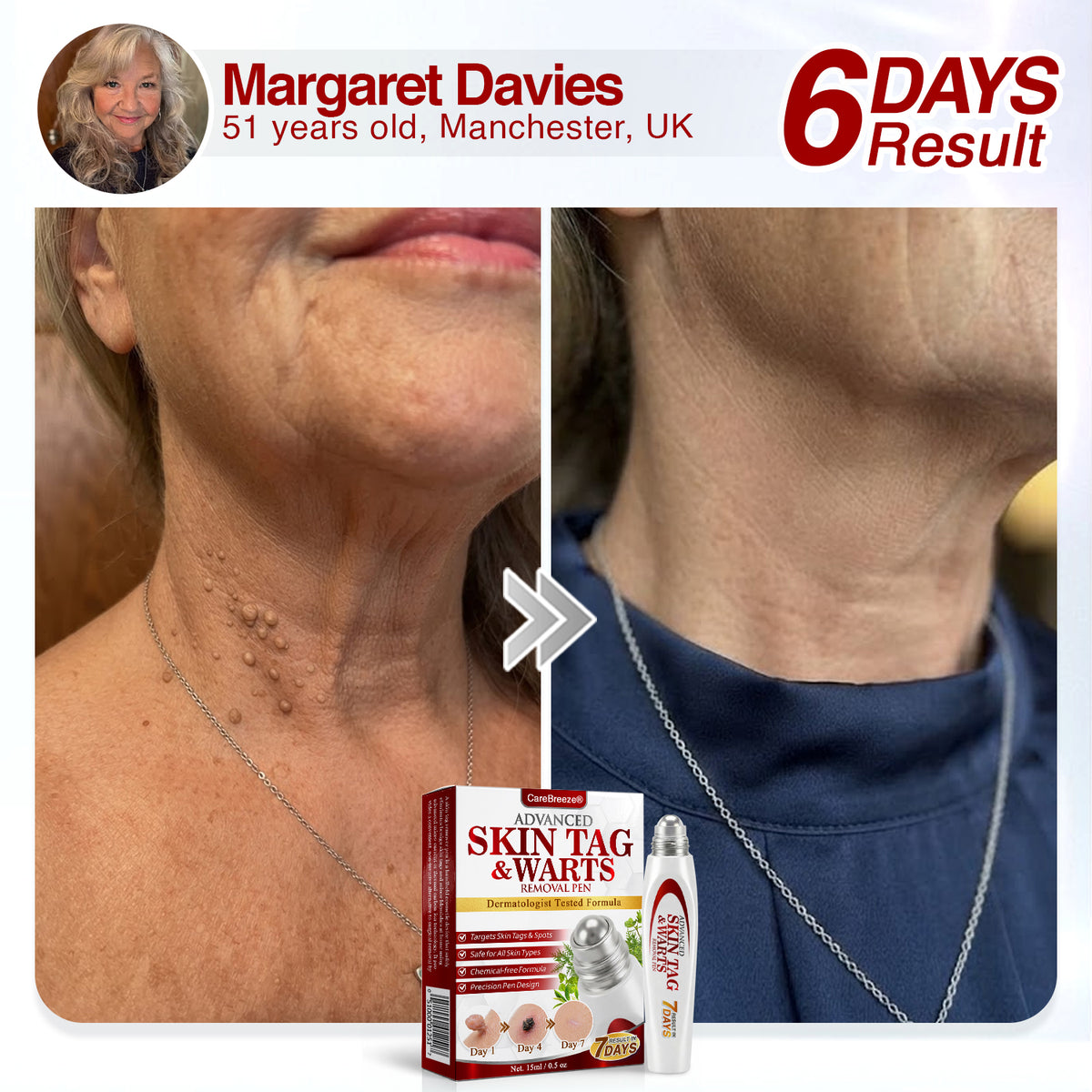 🇬🇧 CareBreeze® Herbal Skin Tag & Wart Removal Roller 👩🏼‍⚕️