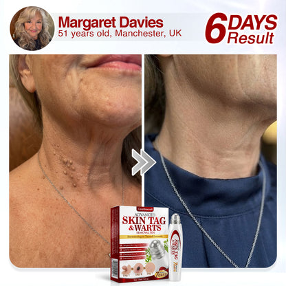 🇬🇧 CareBreeze® Herbal Skin Tag & Wart Removal Roller 👩🏼‍⚕️