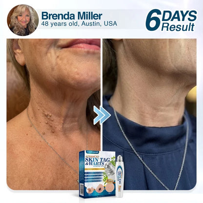 🇬🇧 CareBreeze® Advanced Skin Tag & Wart Removal Roller 🏆