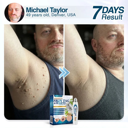 🇬🇧 CareBreeze® Advanced Skin Tag & Wart Removal Roller 🏆