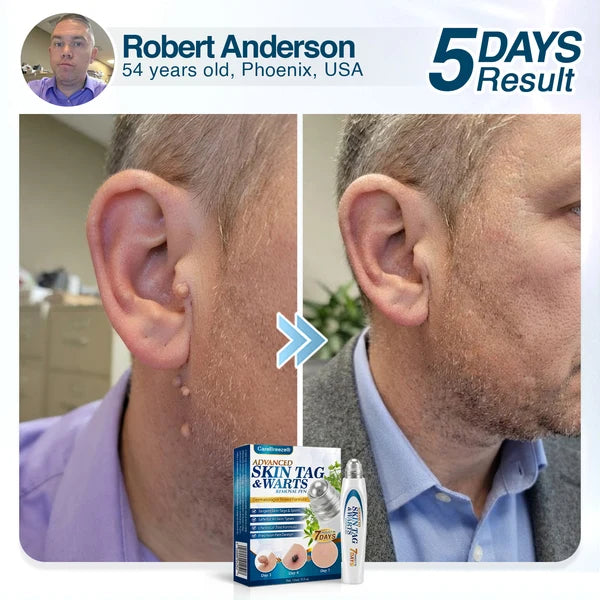 🇬🇧 CareBreeze® Advanced Skin Tag & Wart Removal Roller 🏆