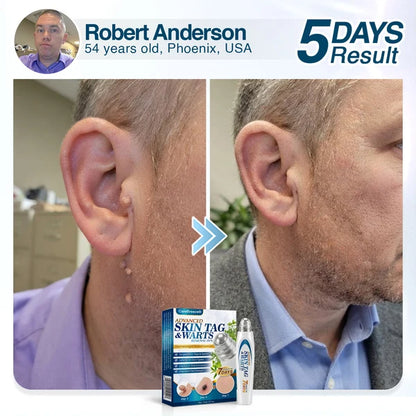🇬🇧 CareBreeze® Advanced Skin Tag & Wart Removal Roller 🏆