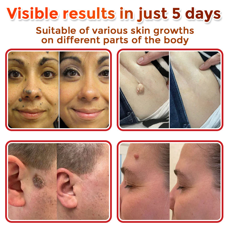 👨‍⚕️🇬🇧 GFOUK® MicroNeedle Botanic Skin Tag Removal Patch 🇬🇧 Aligned with NHS Skincare Guidance