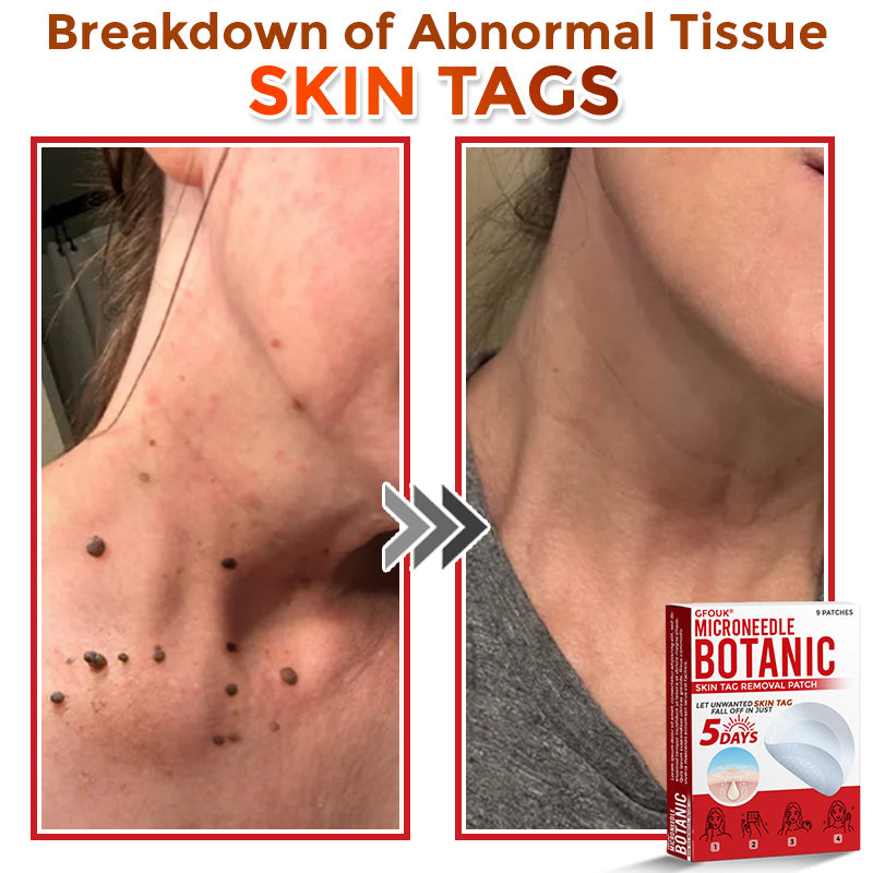 👨‍⚕️🇬🇧 GFOUK® MicroNeedle Botanic Skin Tag Removal Patch 🇬🇧 Aligned with NHS Skincare Guidance
