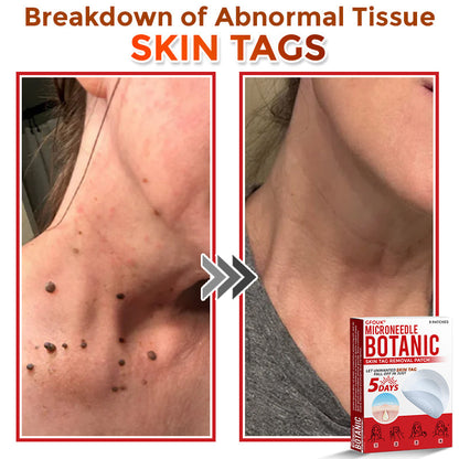 👨‍⚕️🇬🇧 GFOUK® MicroNeedle Botanic Skin Tag Removal Patch 🇬🇧 Aligned with NHS Skincare Guidance