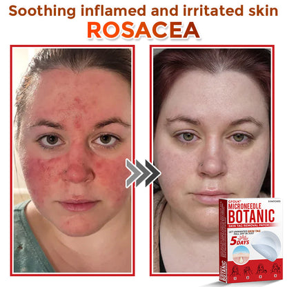 GFOUK® MicroNeedle Botanic Skin Tag Removal Patch ⬆️