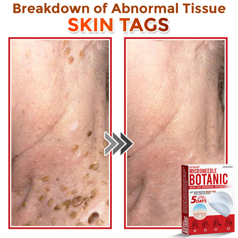 👨‍⚕️🇬🇧 GFOUK® MicroNeedle Botanic Skin Tag Removal Patch 🇬🇧 Aligned with NHS Skincare Guidance