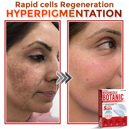 GFOUK® MicroNeedle Botanic Skin Tag Removal Patch ⬆️