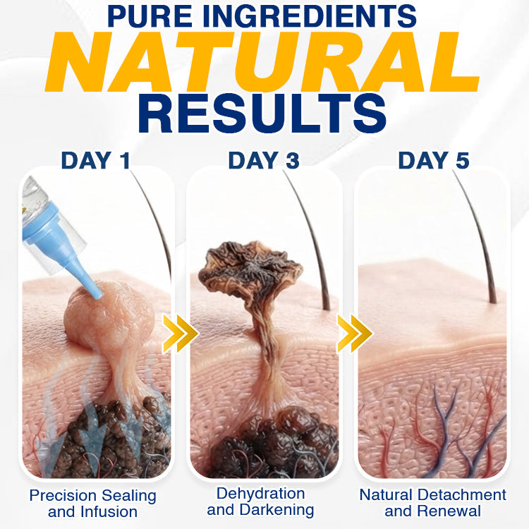 🇬🇧 CareBreeze® Skin Tag Removal Precision Gel 🧑🏻‍⚕️