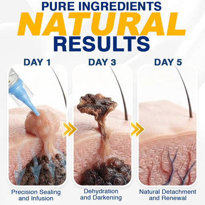 🇬🇧 CareBreeze® Skin Tag Removal Precision Gel 🧑🏻‍⚕️
