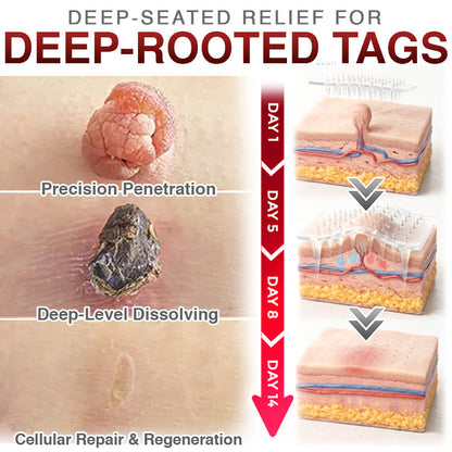 ✅ CareBreeze® Skin Tag Removal Micro-needle Patch