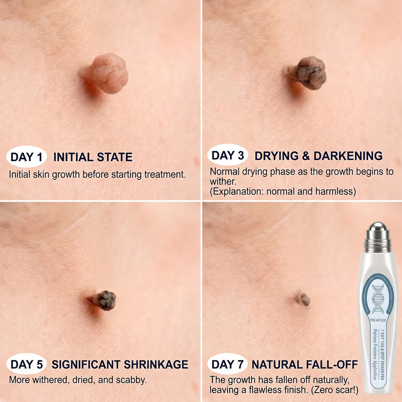 CareBreeze® Advanced Wart & Skin Tag Removal Pen