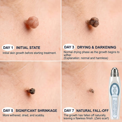 CareBreeze® Advanced Wart & Skin Tag Removal Pen