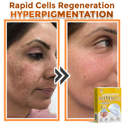 🐝🌿 GFOUK® Bee Venom MicroNeedle Botanic Skin Tag Removal Patch 🇬🇧 Made in the UK