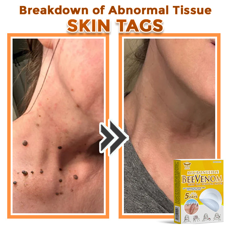 🐝🌿 GFOUK® Bee Venom MicroNeedle Botanic Skin Tag Removal Patch 🇬🇧 Made in the UK