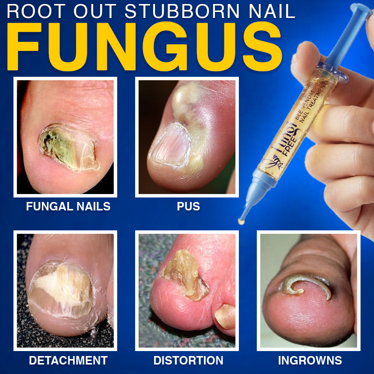 🇬🇧 CareBreeze® Fungi Free Bee Venom Nail Treatment 🐝✨