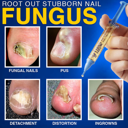 🇬🇧 CareBreeze® Fungi Free Bee Venom Nail Treatment 🐝✨