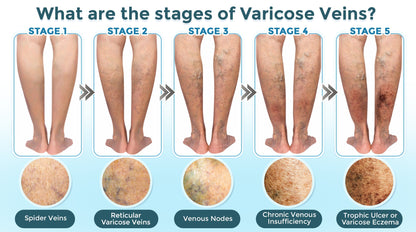 GFOUK® VenaRestore MicroNeedle Vein Repair Patch 🇬🇧