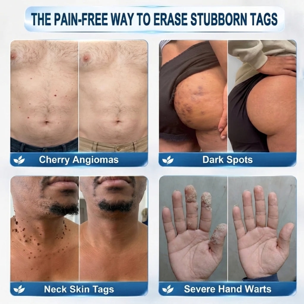 CareBreeze® Advanced Wart & Skin Tag Removal Pen